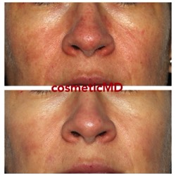 rosace facial redess